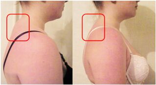 Formation of a muscle cushion in cervical osteochondrosis. 