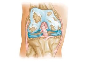 damage to the knee joint with osteoarthritis