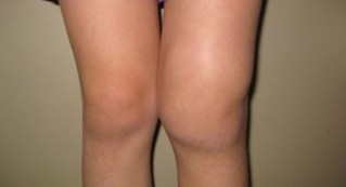 The deformation of the knee